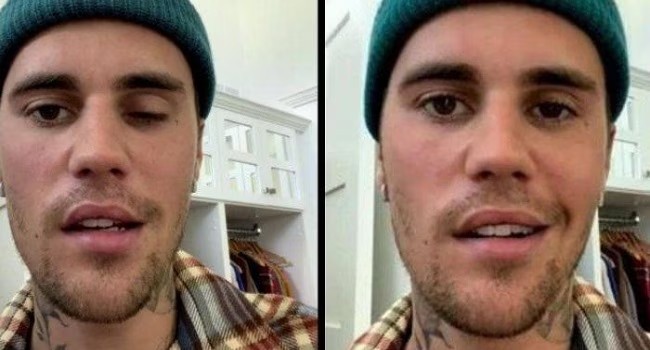 Justin Bieber says suffering from facial paralysis