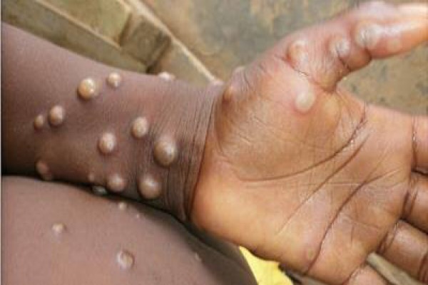 WHO declares Monkeypox global health emergency