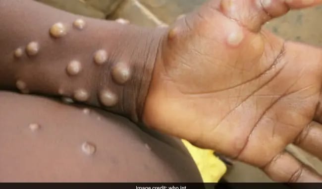 Edo confirms eight cases of monkeypox