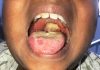 Virologist urges FG to increase immunisation coverage against diphtheria
