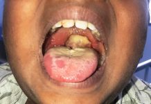 Diphtheria: Everyone is at risk; protect yourselves — FG warns