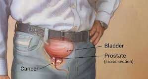Men should eat balanced diet, be sexually active to prevent prostate cancer – Experts
