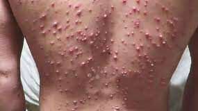 Chicken pox outbreak: AMAC sends response team to affected community