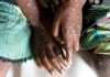 Travellers advised to consider mpox vaccine