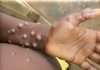 Cross River confirms the first mpox case