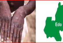 Edo records three suspected cases of Mpox – Official