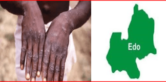 Edo records three suspected cases of Mpox – Official