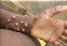 Cross River Govt confirms one case of Mpox