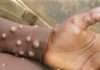 Akwa Ibom records five Mpox cases