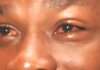 Apollo cases confirmed in Yobe as eye infection spreads