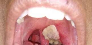 Diphtheria outbreak kills over 50 children in Kano