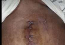 Abuja Woman, Jane Apollos, Needs N6m For Life-Saving Intestinal Surgery After Cancer Battle