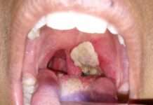 Plateau orders statewide school closure over diphtheria outbreak